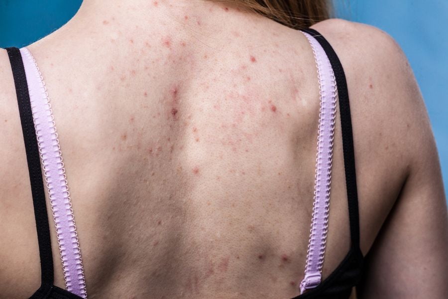 Costas de pessoa com acne na região. 