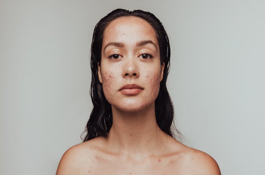 Mulher adulta latina com acne no rosto e no colo.