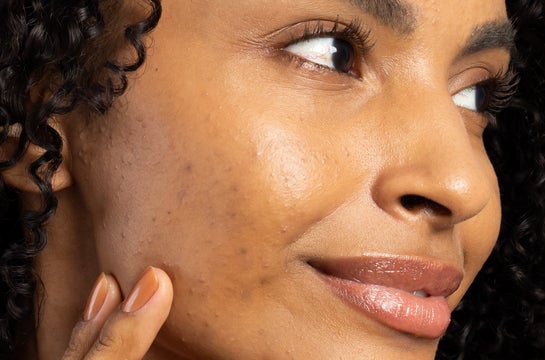 Close-up do rosto de uma mulher negra com pele acneica. Ela sorri suavemente, seus lábios brilhantes realçados por um batom nude ou gloss. Seus cabelos cacheados escuros emolduram o rosto, enquanto sua mão delicadamente toca sua face, com unhas pintadas em um tom laranja.